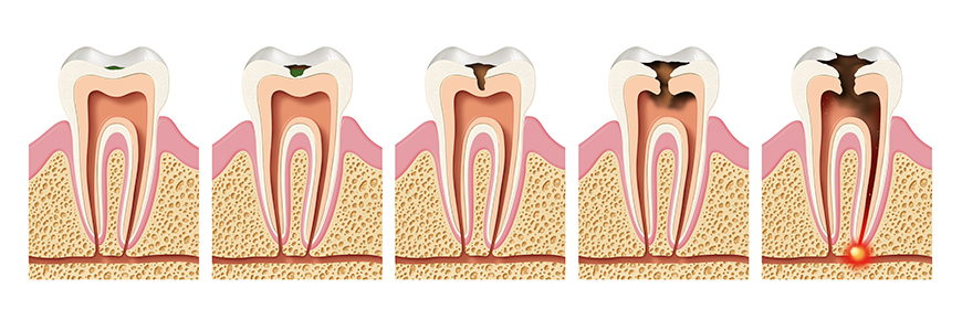 vývoj zubního kazu