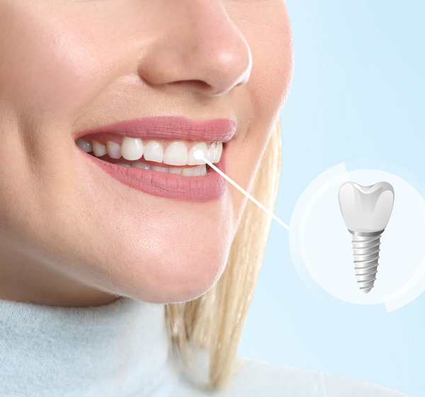 zubní implantáty Clinic for Smile