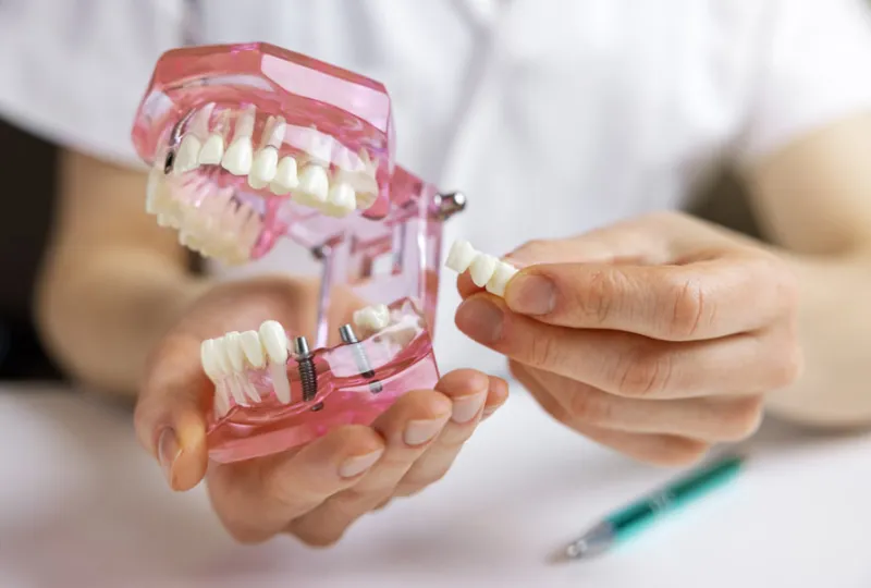 Zubní implantáty