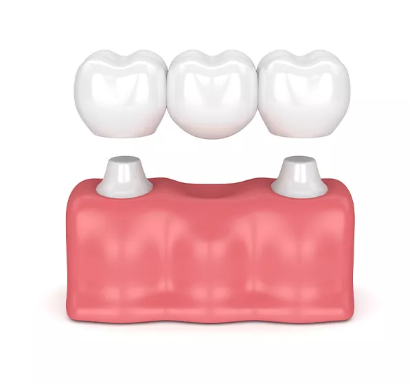 Zubní můstek