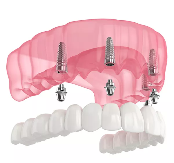 Zubní implantáty all on 4